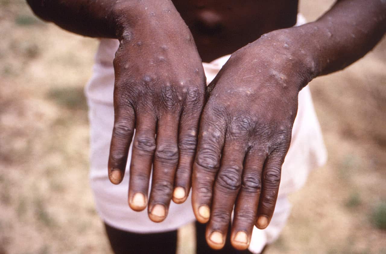 Hands infected with monkeypox virus